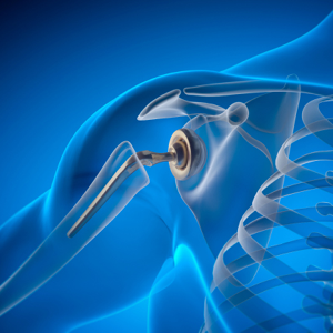 Illustration of a shoulder joint replacement implant