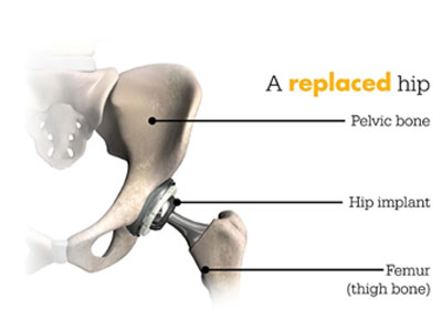 Illustration of a replaced hip