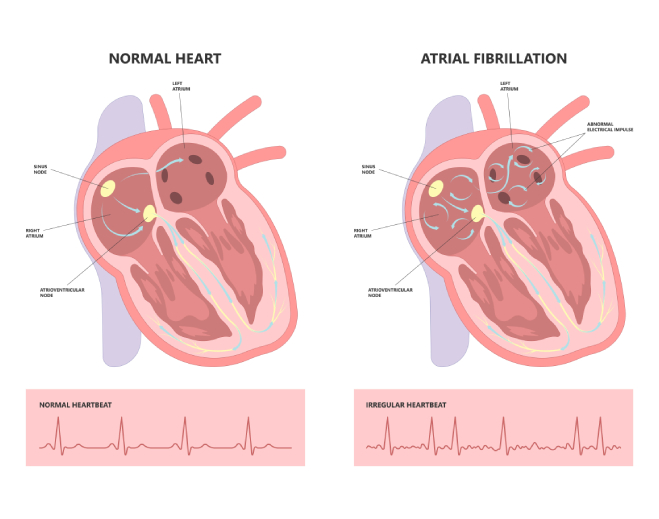 afib