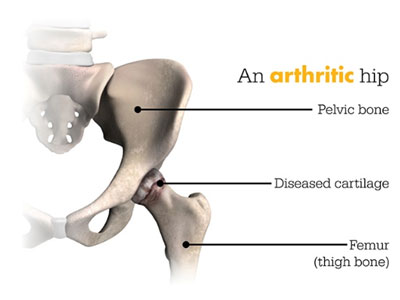 Illustration of an arthritic hip
