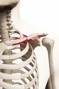Illustration of a broken collarbone