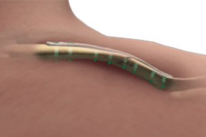 Collarbone with surgical plate and screws