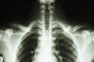 Chest X-ray showing ribcage