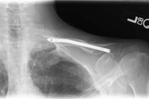 Collarbone with surgical plate and screws