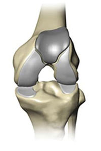 patellofemoral-200x300