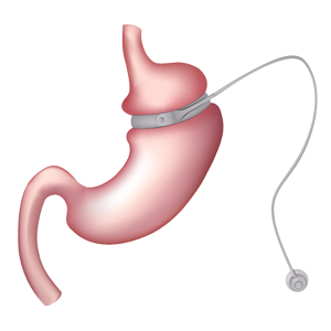 PBHN-BRND-Web Content Update-Adjustable Gastric Band-DIG-WEB-300x300-2026_01