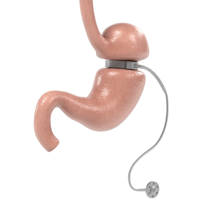 PBHN-BRND-Web Content Update-Gastric Band Care-DIG-WEB-300x300-2026_04