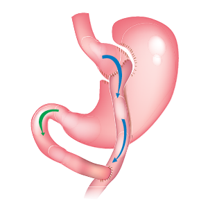 PBHN-BRND-Web Content Update-Gastric Bypass-DIG-WEB-300x300-2026_02