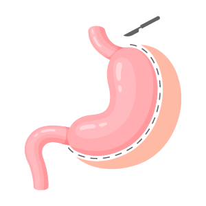PBHN-BRND-Web Content Update-Gastric Sleeve-DIG-WEB-300x300-2026_01