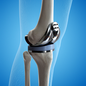 PBHN-BRND-Web Content Update-Knee Replacement-DIG-WEB-300x300-2026_01