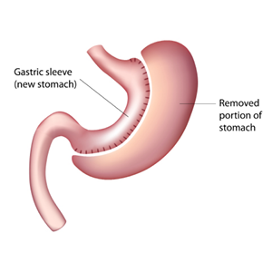 PBHN-BRND-Web Content Update-Sleeve Gastrectomy-DIG-WEB-300x300-2026_02