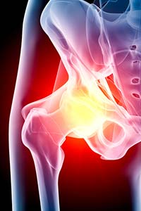 X-ray showing hip joint inflammation