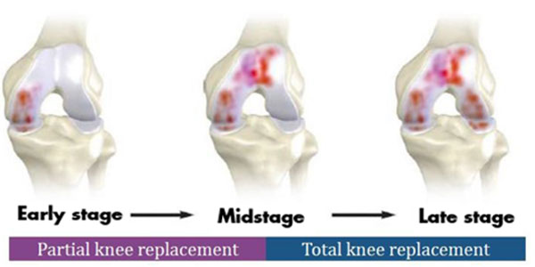 total-knee-vs-partial-knee-replacement-600x300