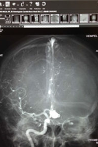 Brain scan with artery contrast
